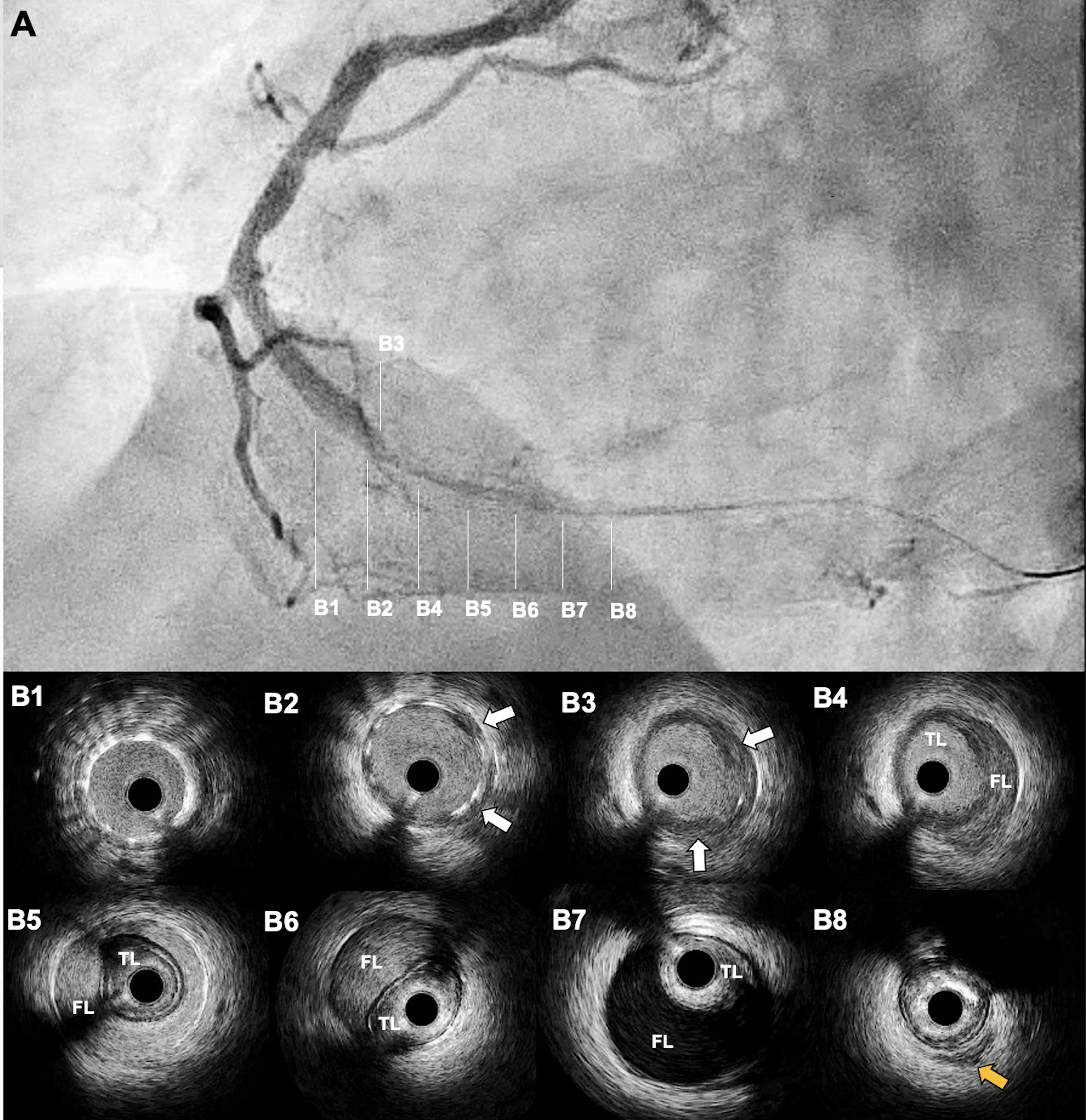 Figure 2. Second coronary angiography