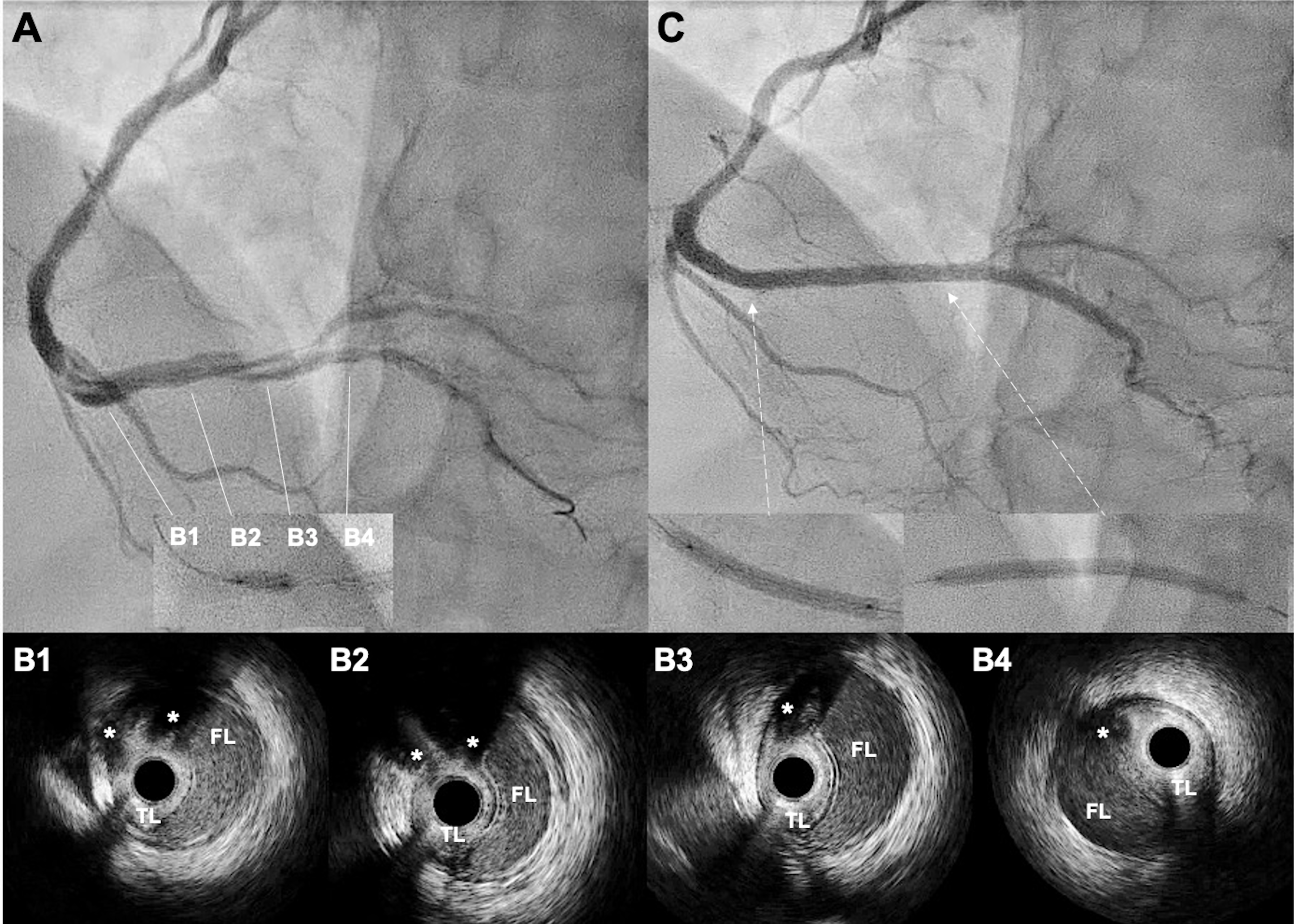 Figure 3.  Angiographic dissection image