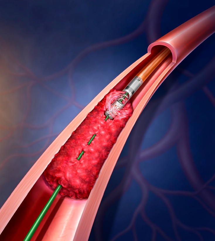 Rotarex thrombectomy (BD)