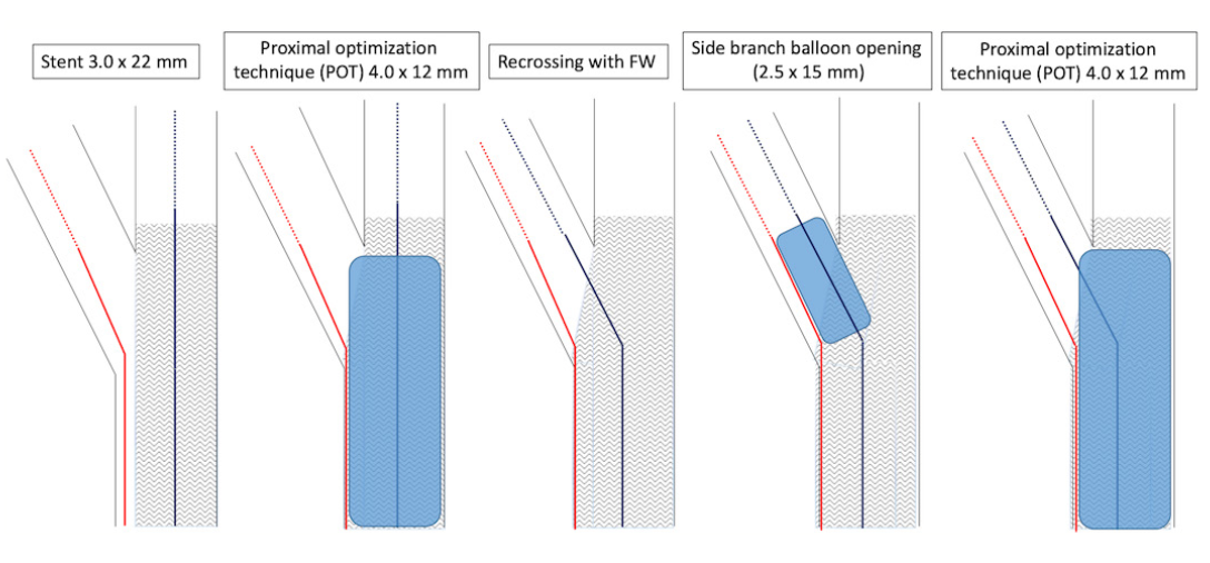 Rubimbura Bifurcation-PCI Figure 2