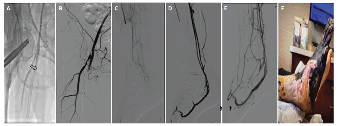 Figure 1. Occluded right superficial femoral artery stent complex after recent revascularization.