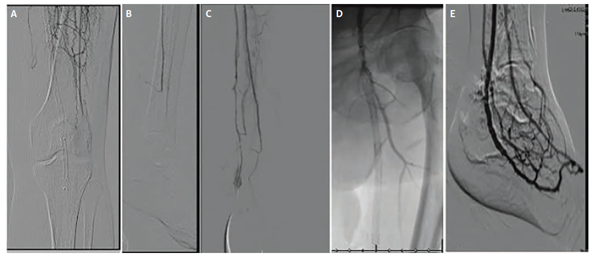 Figure 2. Acute femoral stent occlusion.