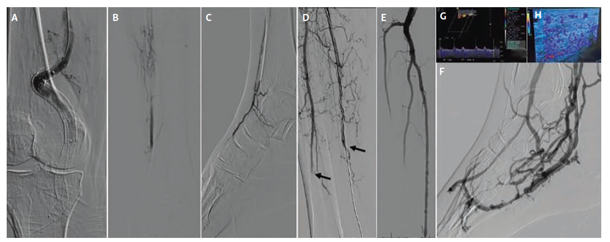 Figure 3. Patient with acute thrombosis after prior endovascular popliteal aneurysm repair.