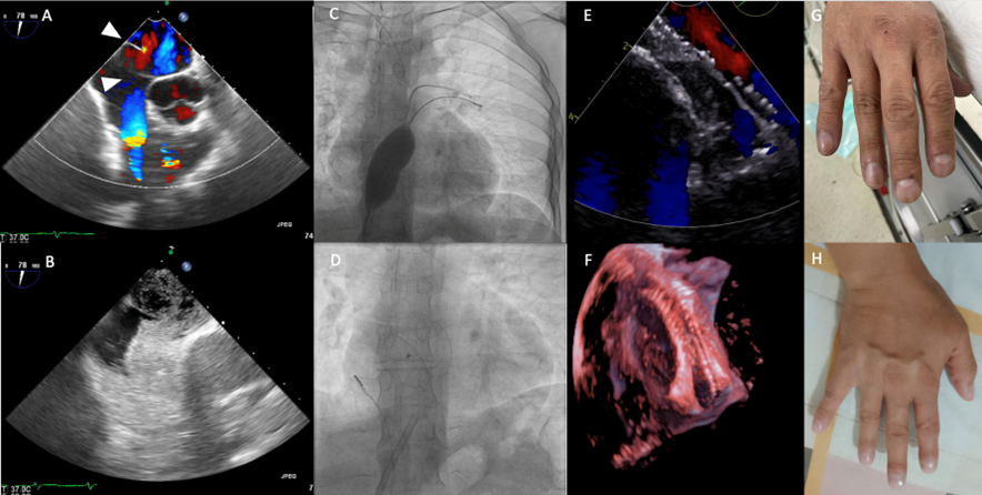 Figure.  Short axis transesophageal echocardiography