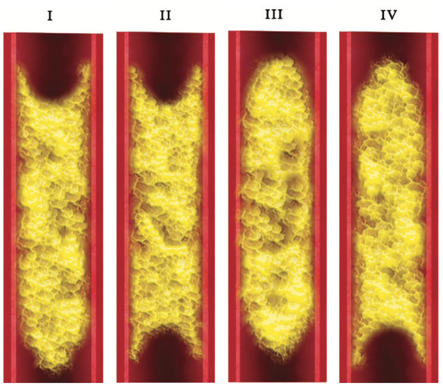 Saab Limb Salvage Figure 1