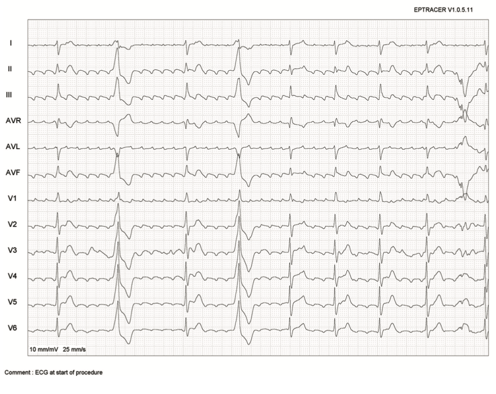 Saad Zero Fluoroscopy Ablation Figure 1