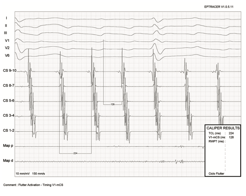 Saad Zero Fluoroscopy Ablation Figure 2