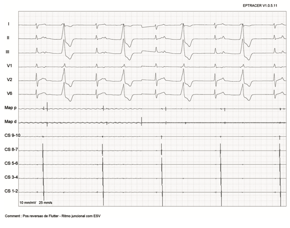 Saad Zero Fluoroscopy Ablation Figure 3