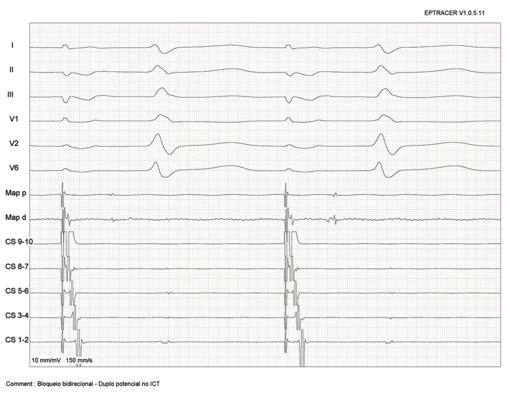 Saad Zero Fluoroscopy Ablation Figure 4