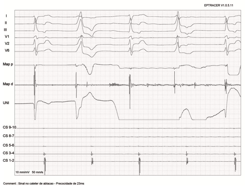 Saad Zero Fluoroscopy Ablation Figure 5
