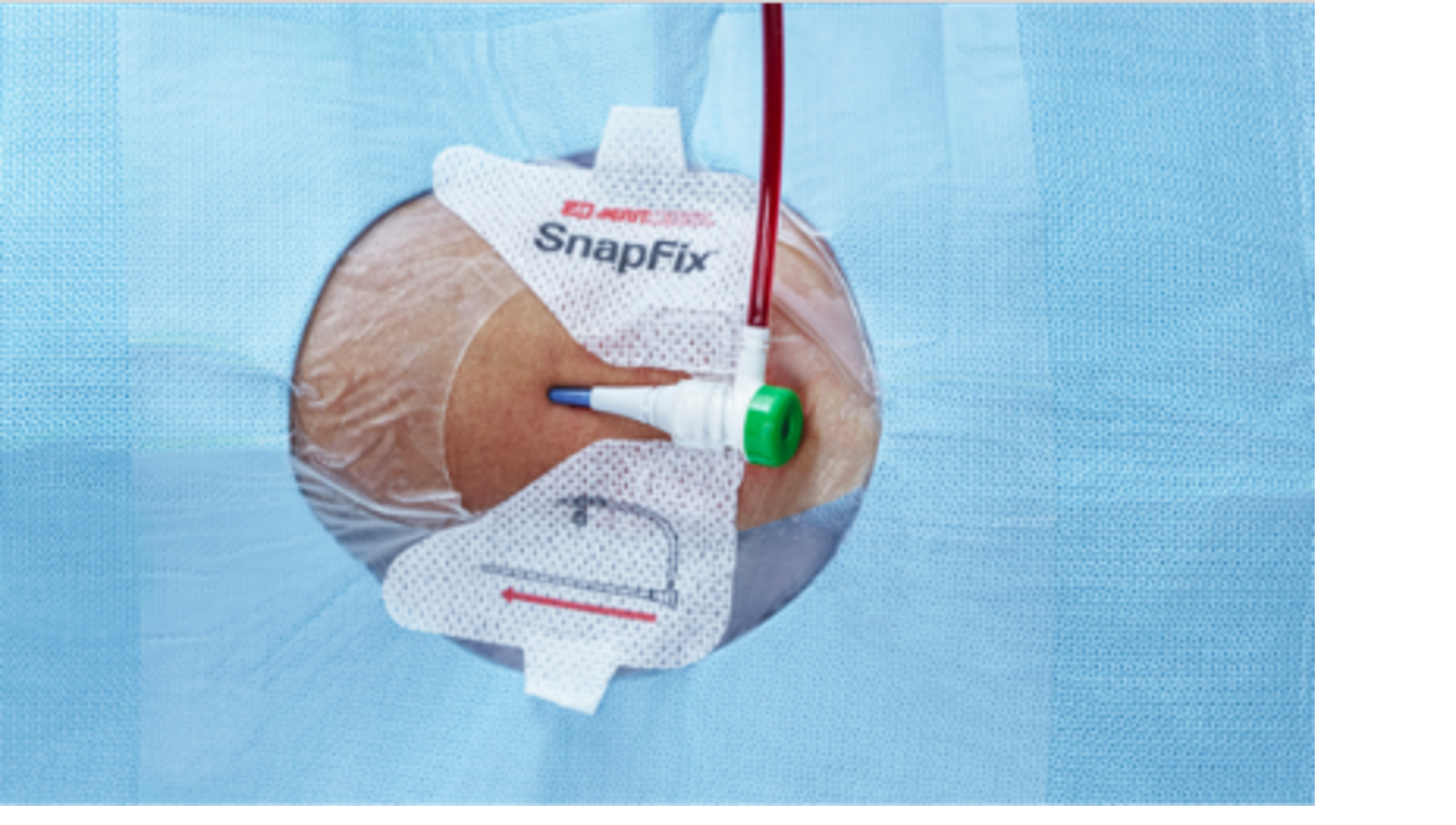 Figure 1. Circular draping setup. Photo courtesy Merit Medical.
