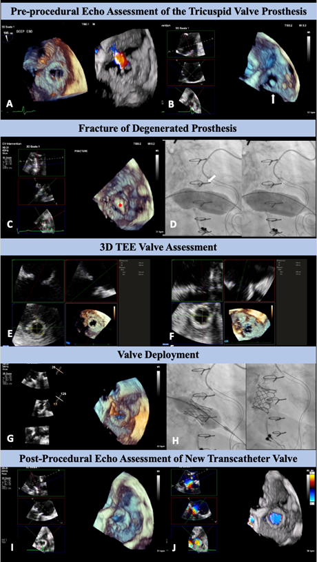 Figure. Images from a 65-year-old woman with degenerated 27-mm Epic tricuspid valve prosthesis (Abbott).