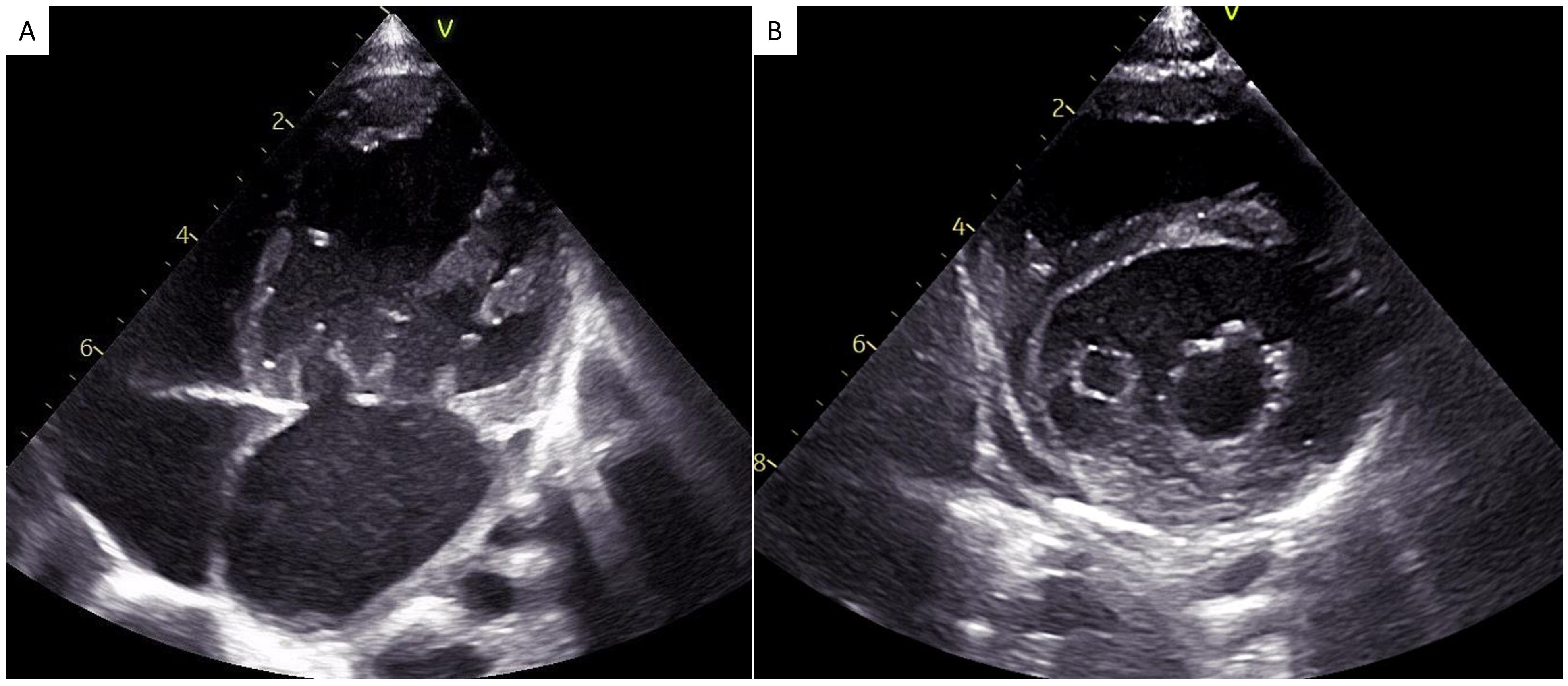 Figure. Two-dimensional transthoracic echocardiographic images
