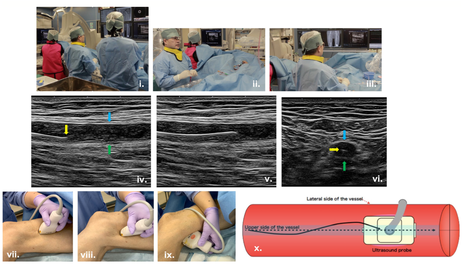 Sakamoto Chronic Total Occlusion Figure 2