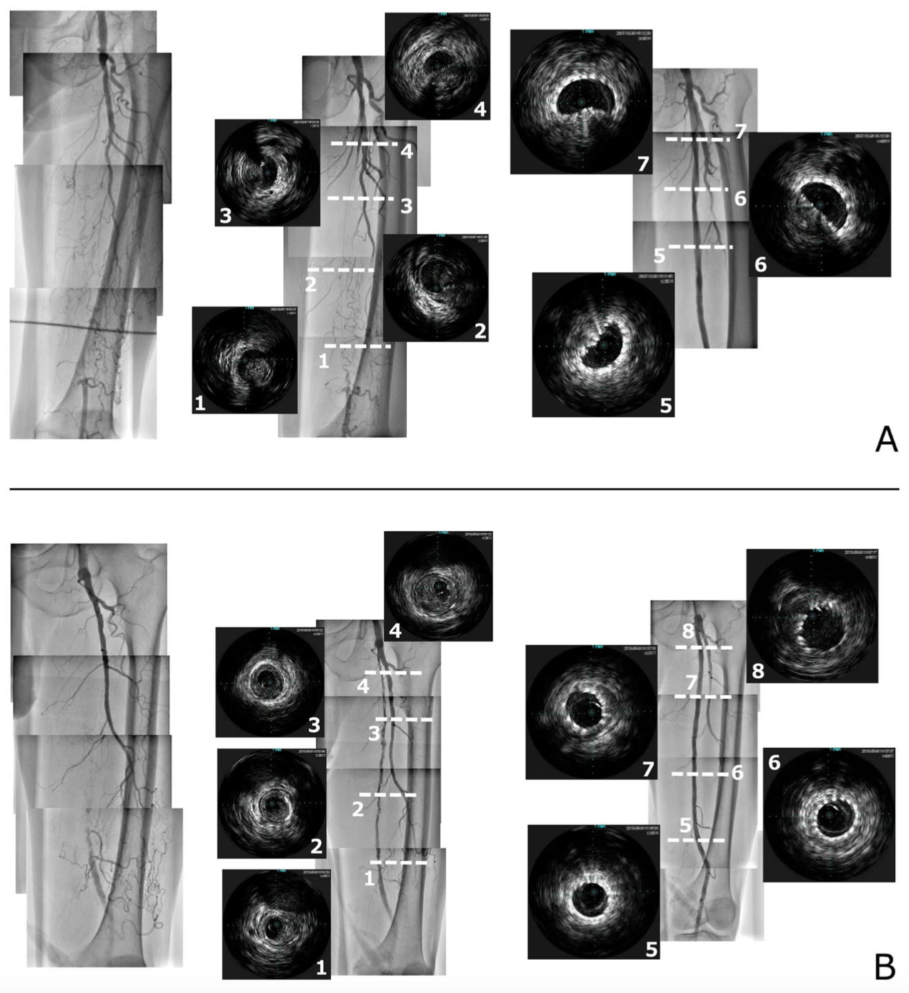 Sakamoto Chronic Total Occlusion Figure 3