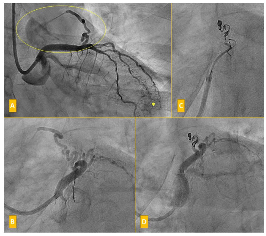 Sanchez Artery Fistula Figure 1