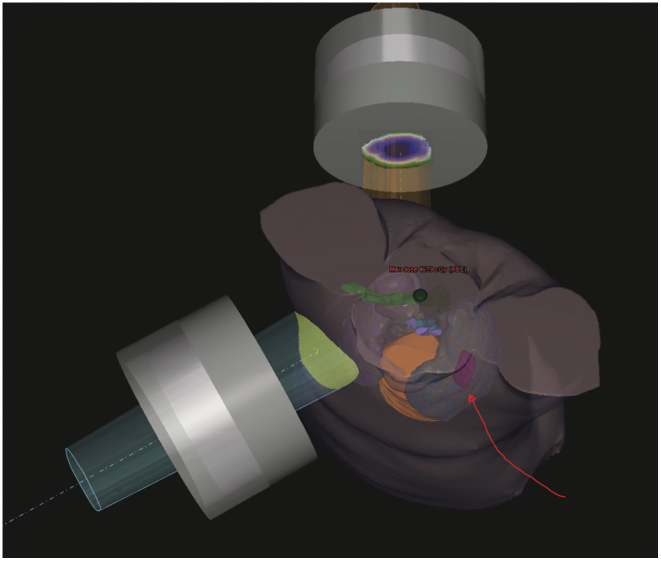 Sanghvi Pacemaker Figure