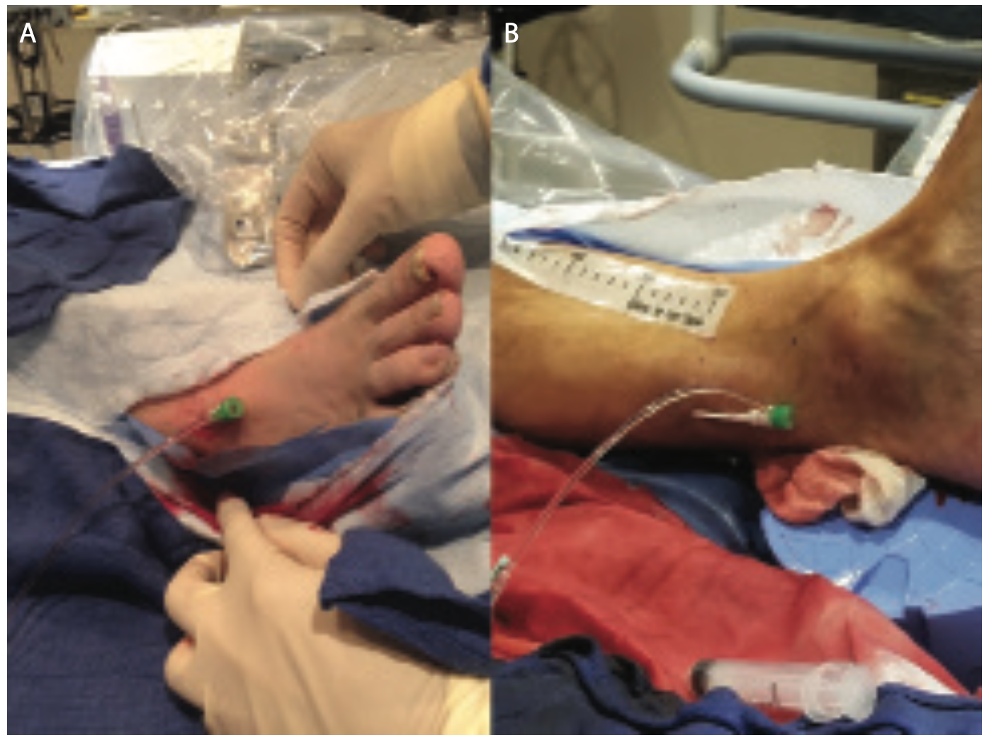 Sanghvi Revascularization Figure 1