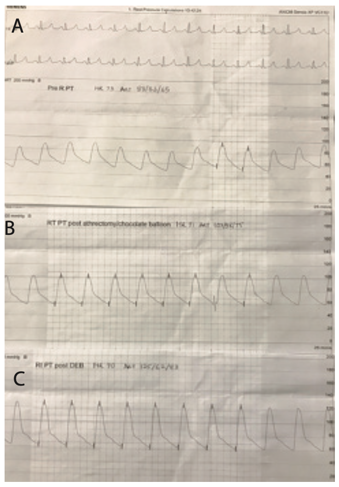 Sanghvi Revascularization Figure 2