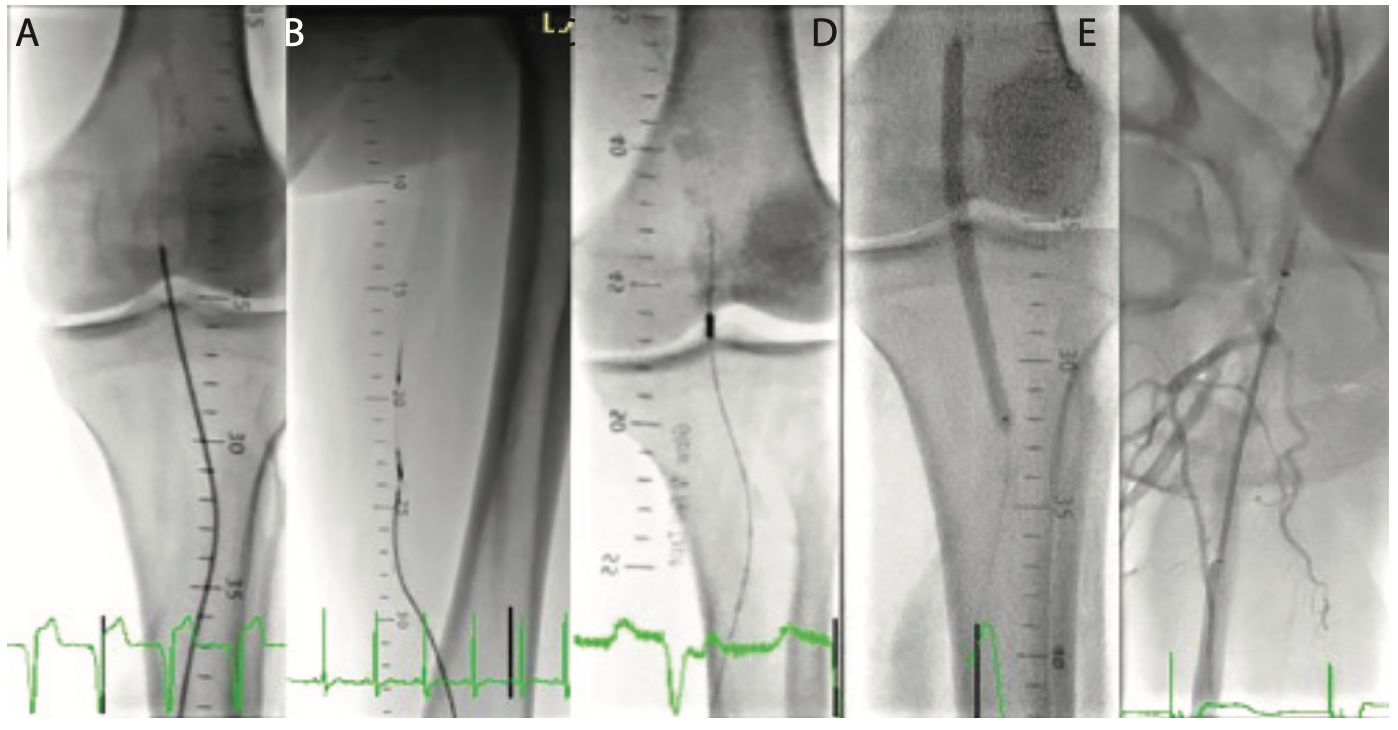 Sanghvi Revascularization Figure 5