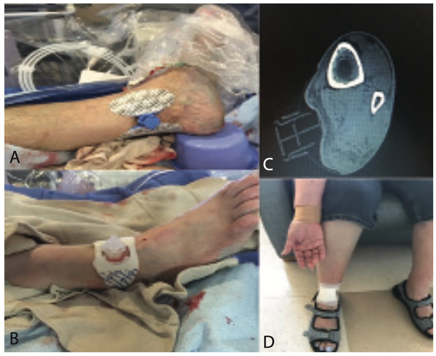 Sanghvi Revascularization Figure 6