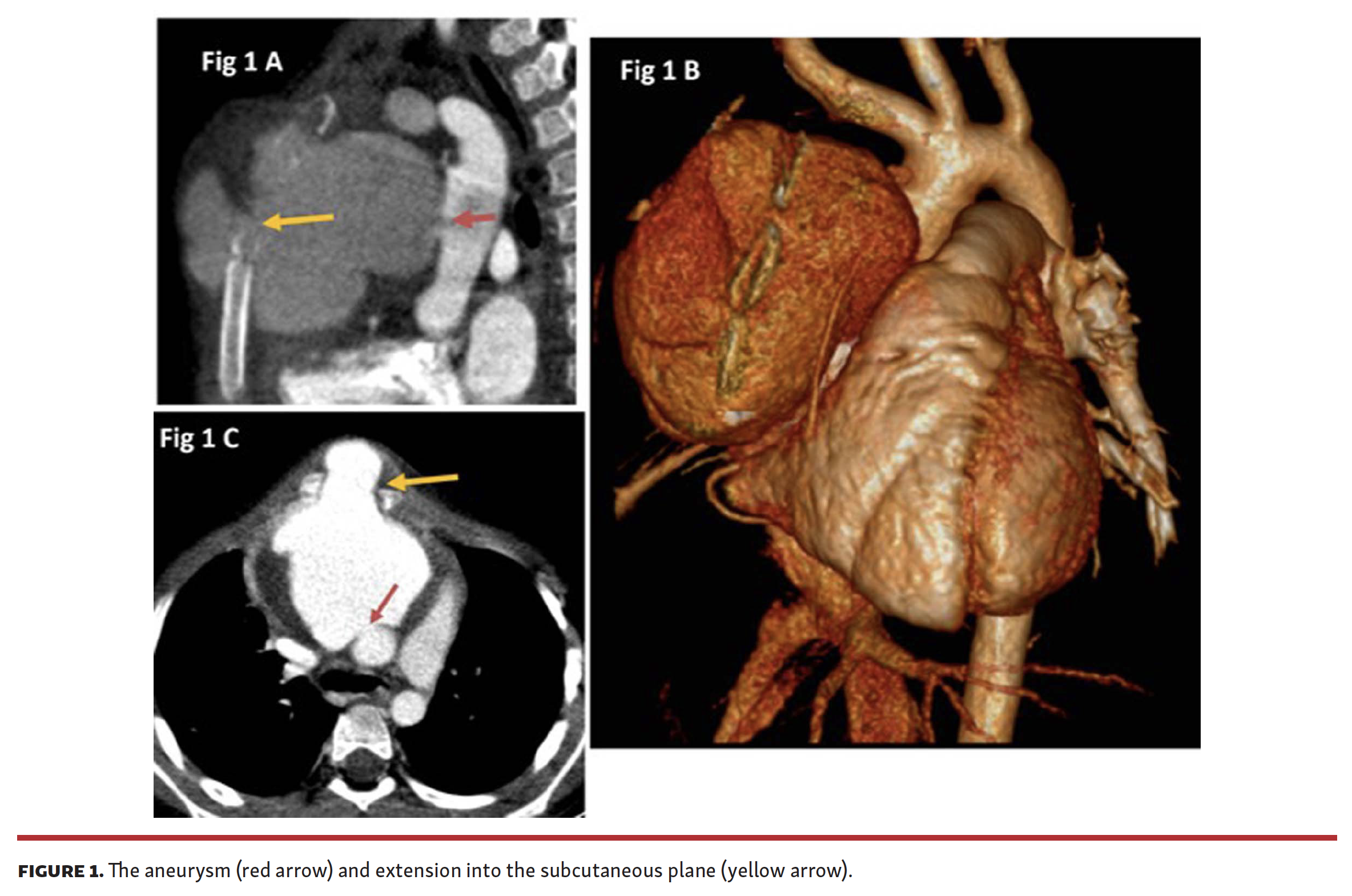Sasikumar Giant Aortic Pseudoaneurysm in a Child Fig 1