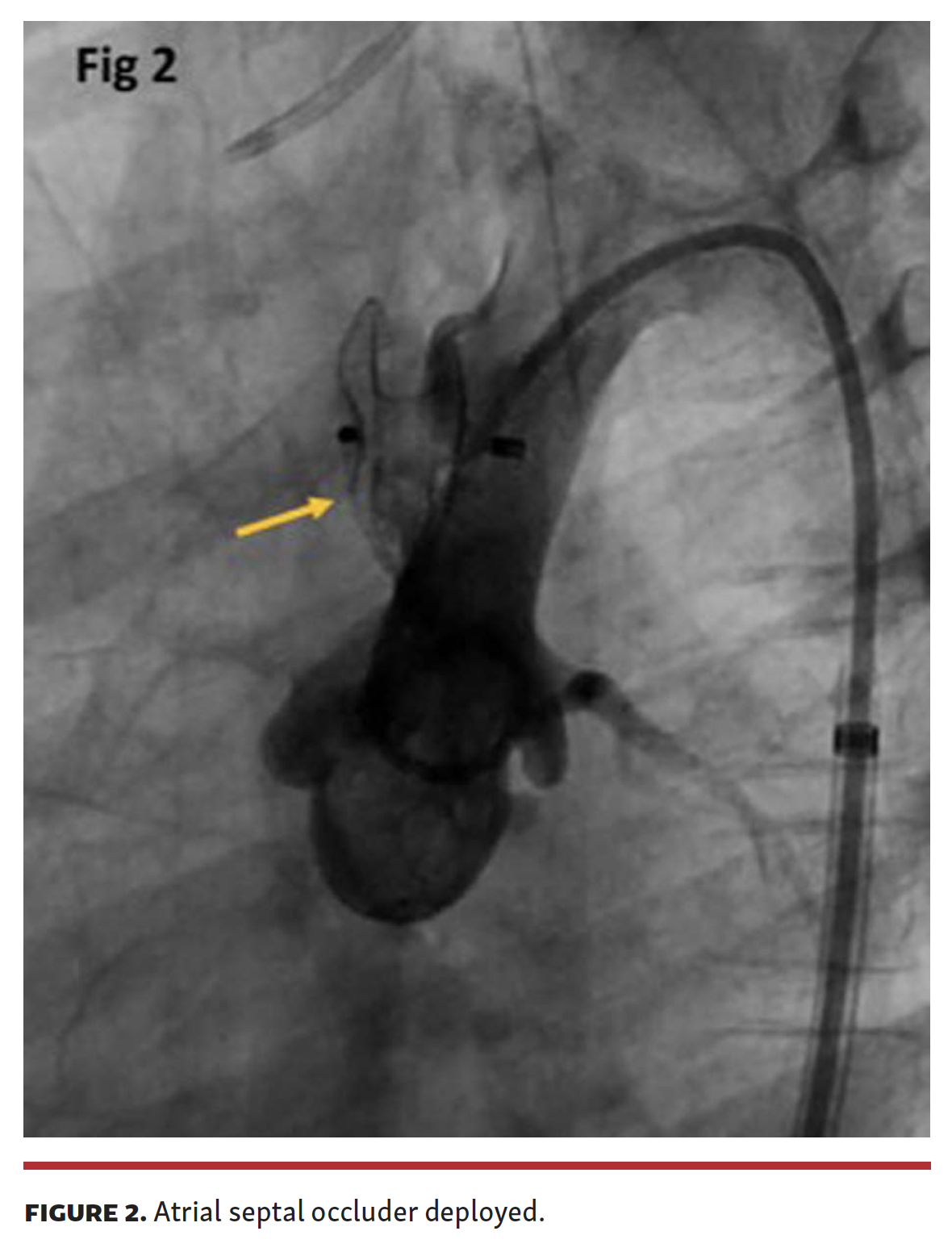 Sasikumar Giant Aortic Pseudoaneurysm in a Child Fig 2