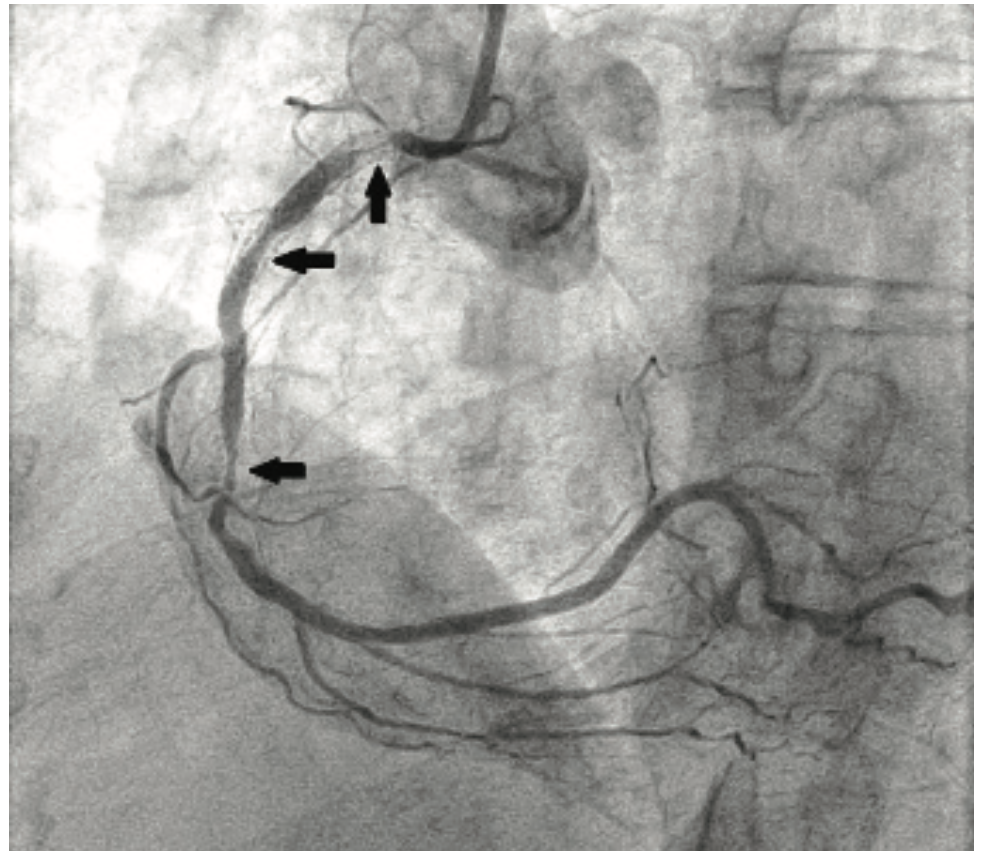 Savage Brachytherapy Figure 2A