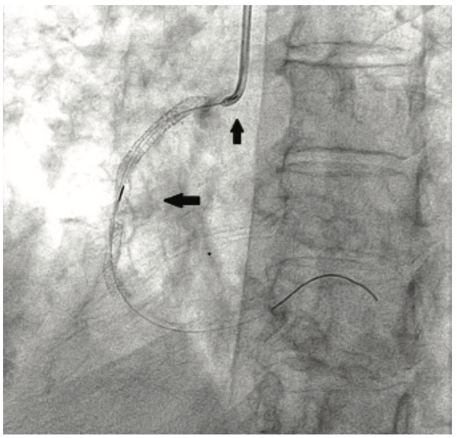 Savage Brachytherapy Figure 2B