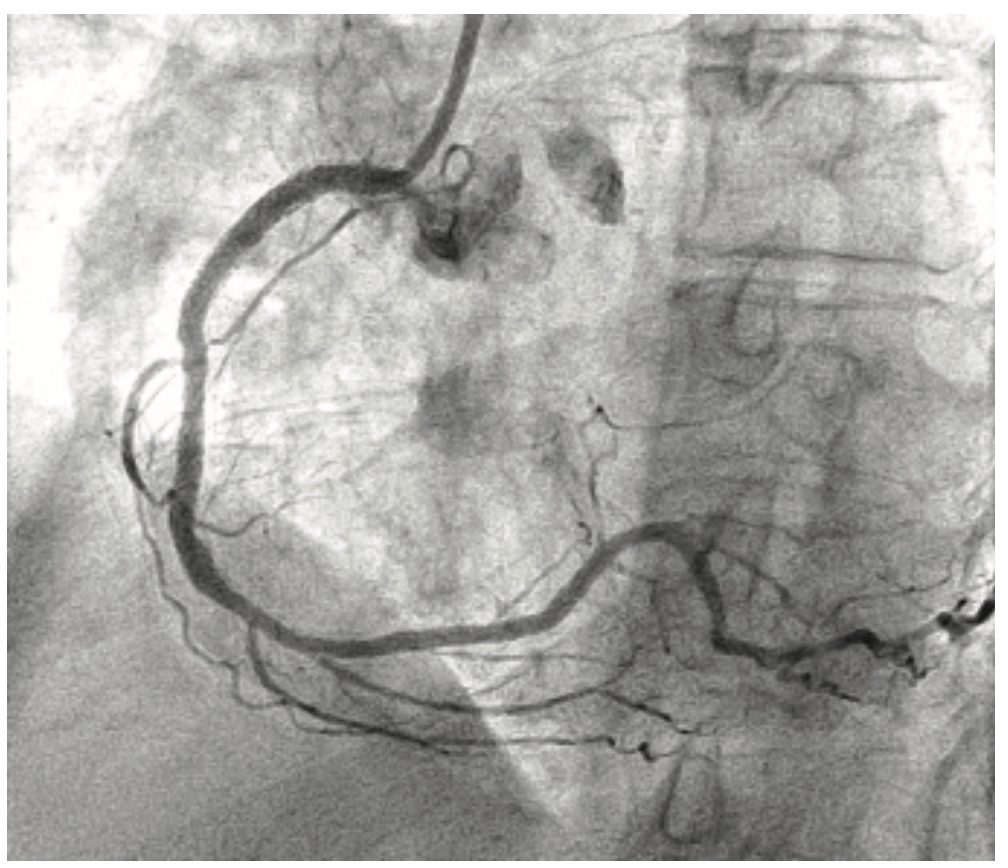 Savage Brachytherapy Figure 2C