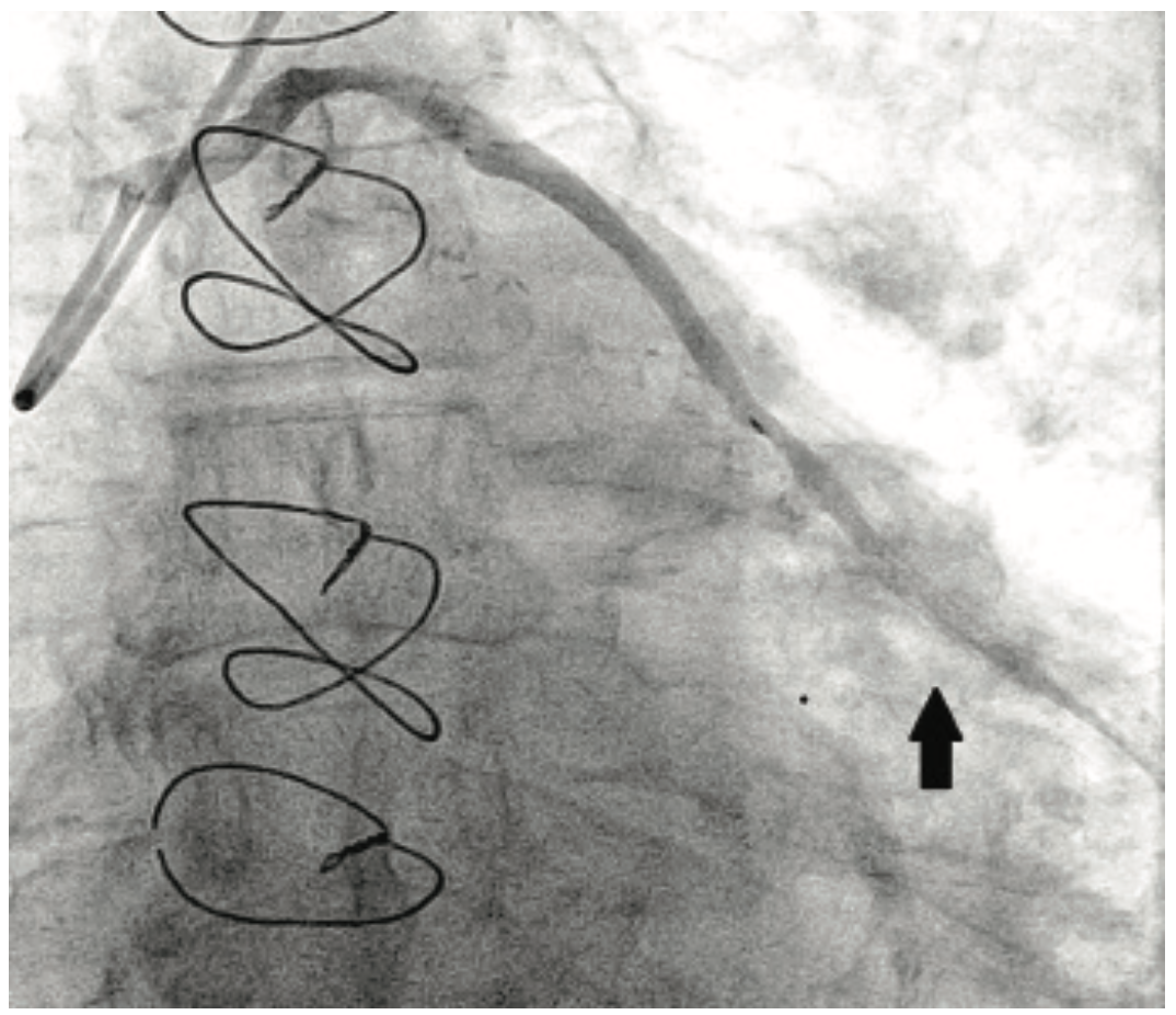 Savage Brachytherapy Figure 4A