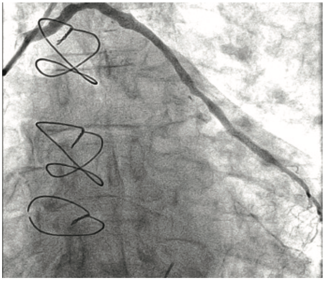 Savage Brachytherapy Figure 4B