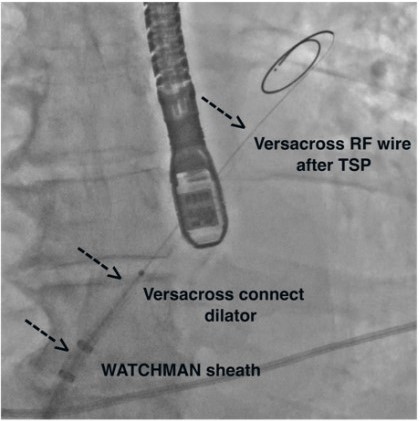 Multipurpose Radiofrequency Wire System Improves Procedural Workflow ...