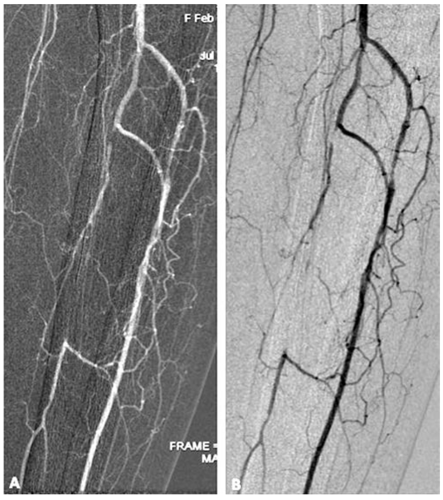 Scalise Angiography Figure 1