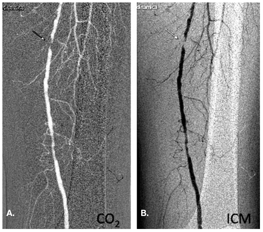 Scalise Angiography Figure 3