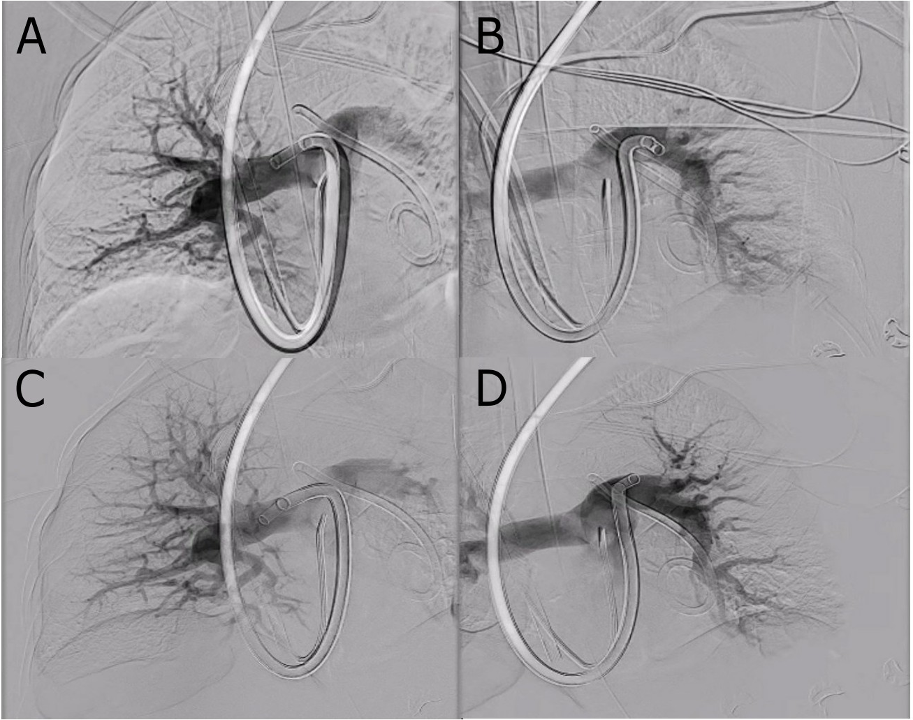 Figure. (A) Right and (B) left pulmonary artery