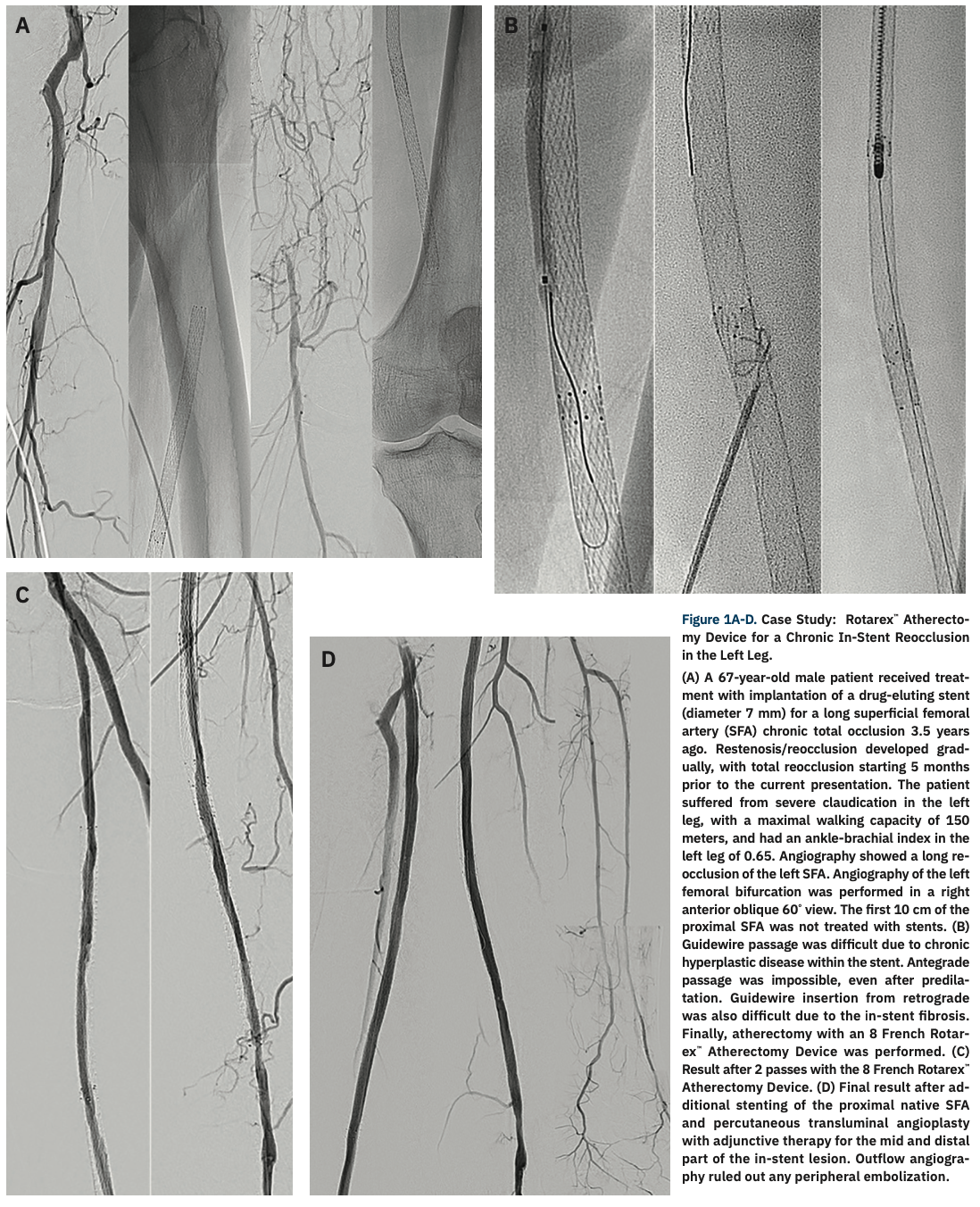 Schmidt Rotarex Figure 1