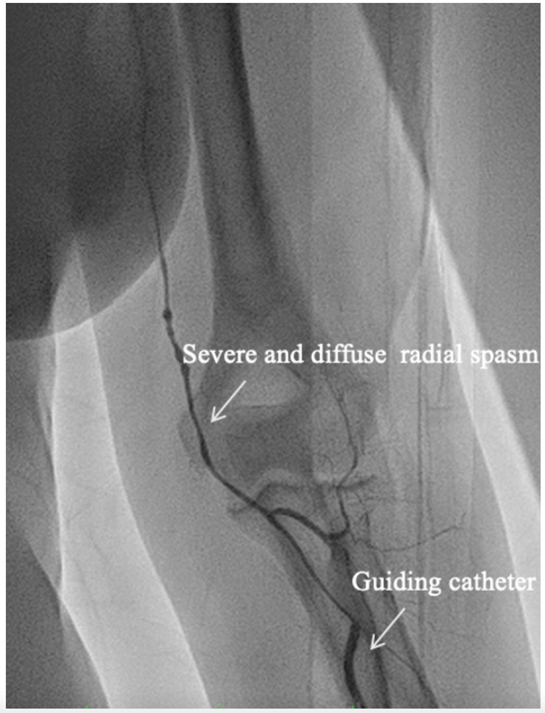 Scoccia MiCAT Figure 4