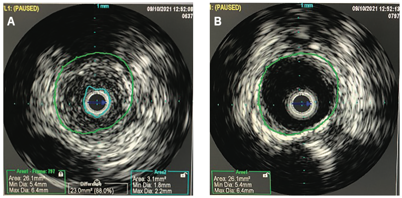 Scott Femoral Bifurcation Figure 2