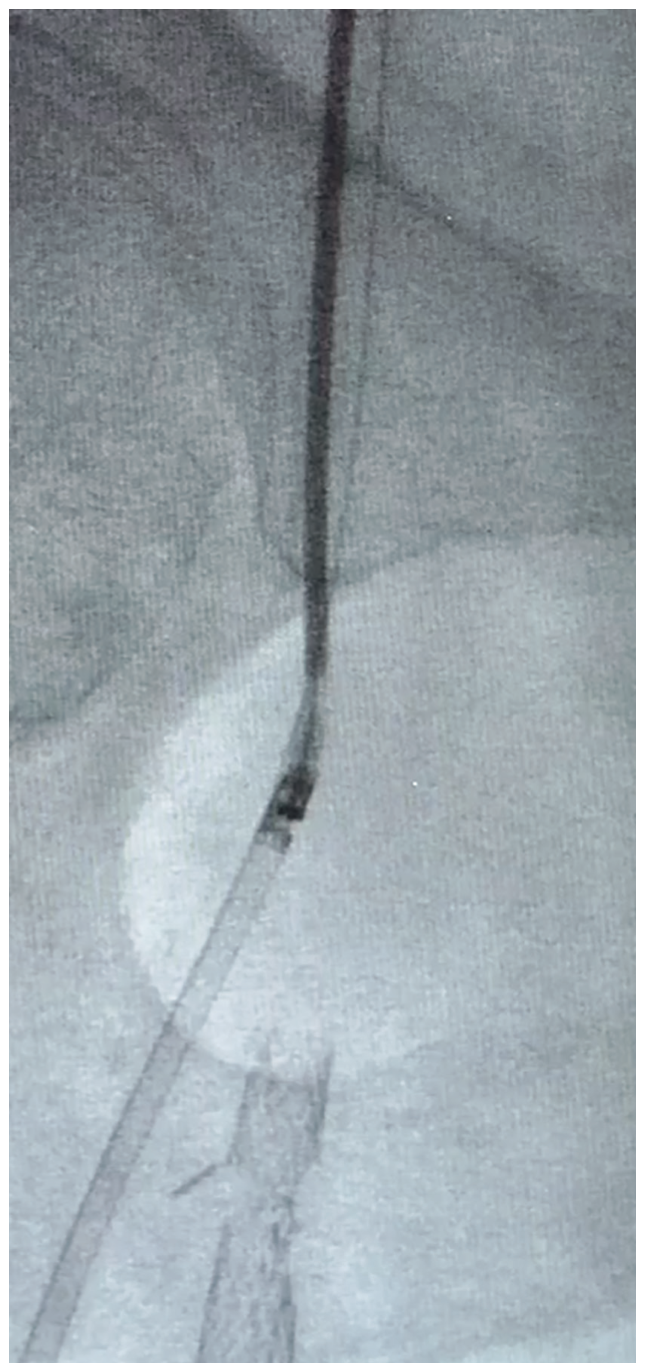 Scott Femoral Bifurcation Figure 3
