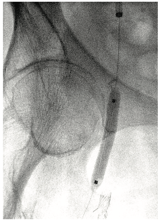 Scott Femoral Bifurcation Figure 5