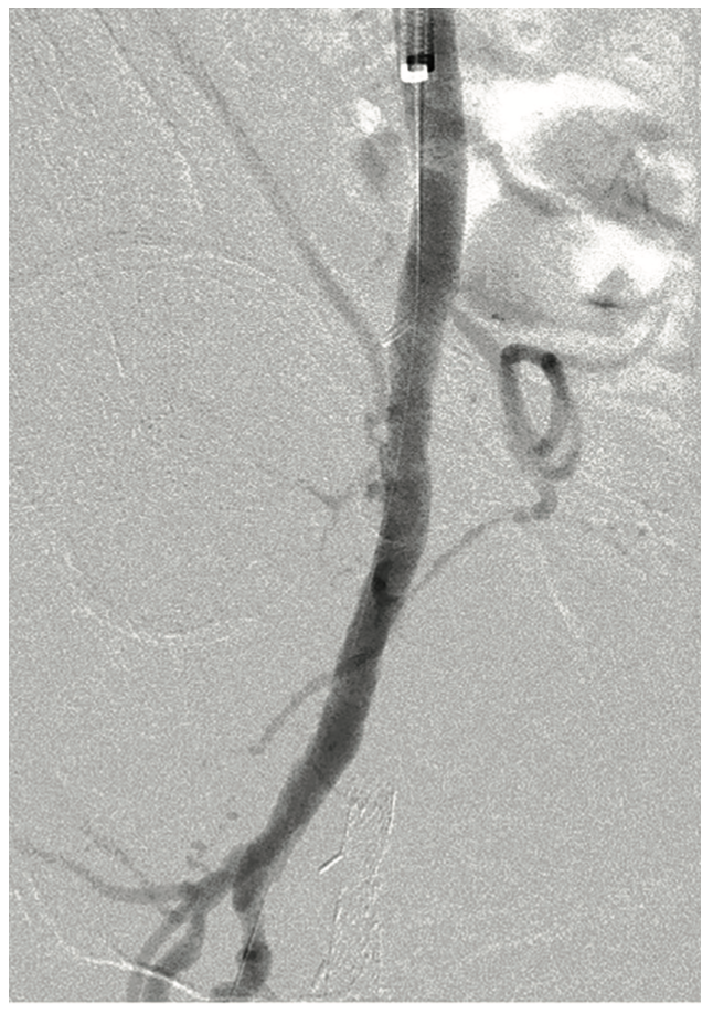 Scott Femoral Bifurcation Figure 6