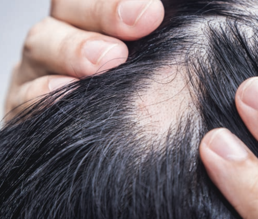 alopecia