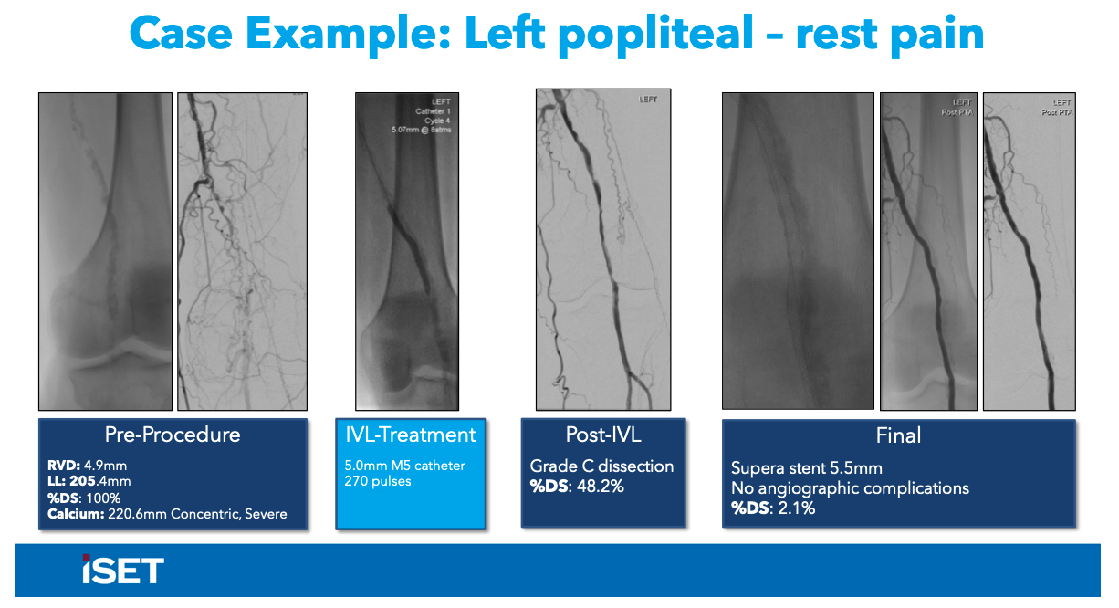 Holden IVL Case Examples