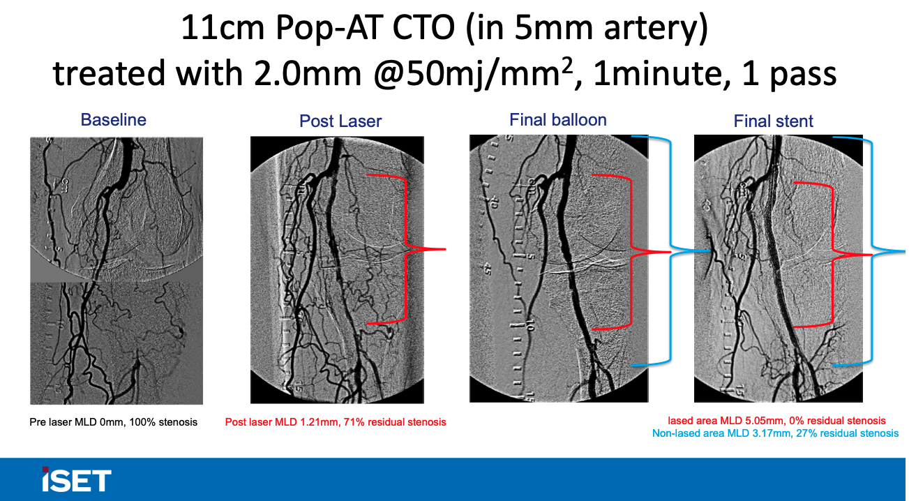 Rundback Auryon Case Example 