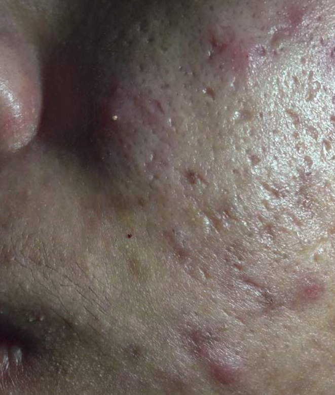 Acne scarring
