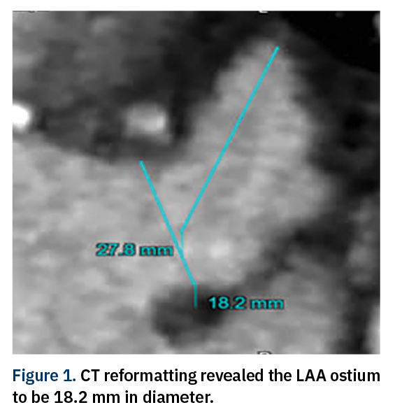 Sanchez 4D ICE Figure 1