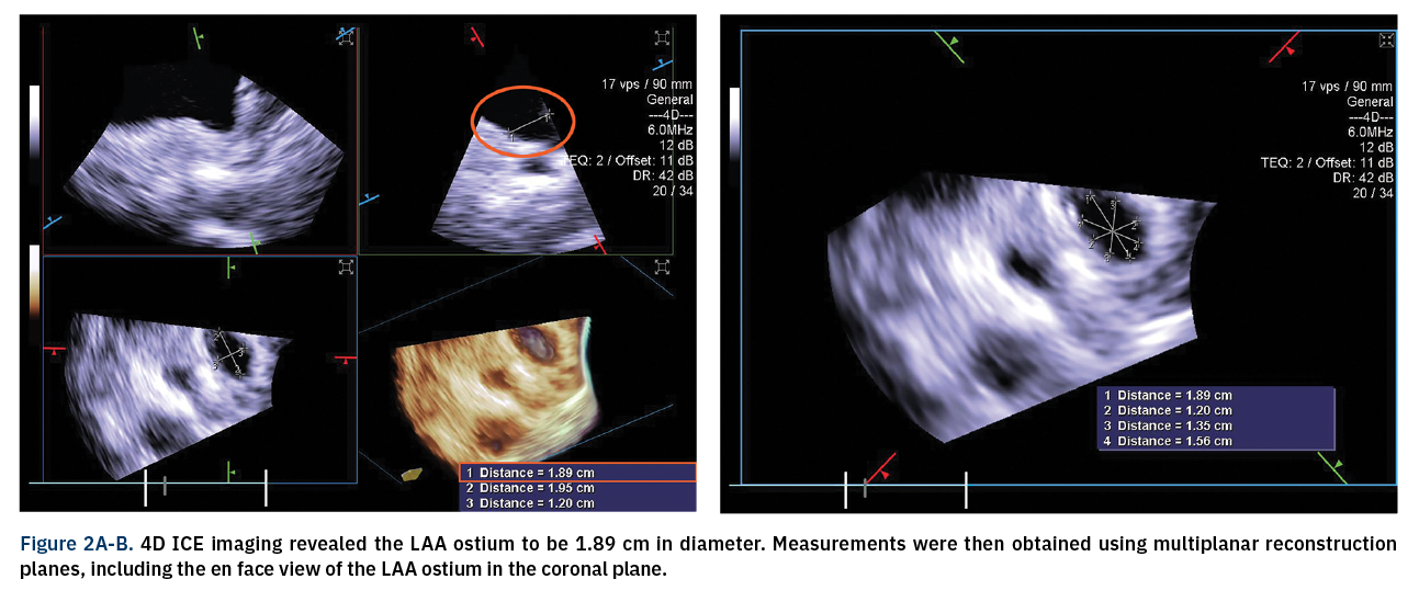 Sanchez 4D ICE Figure 2A-B