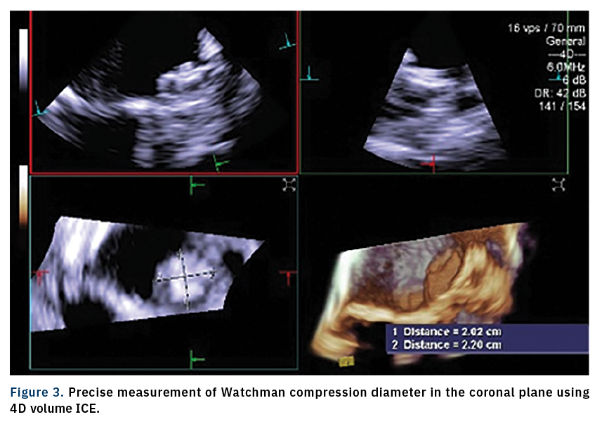 Sanchez 4D ICE Figure 3