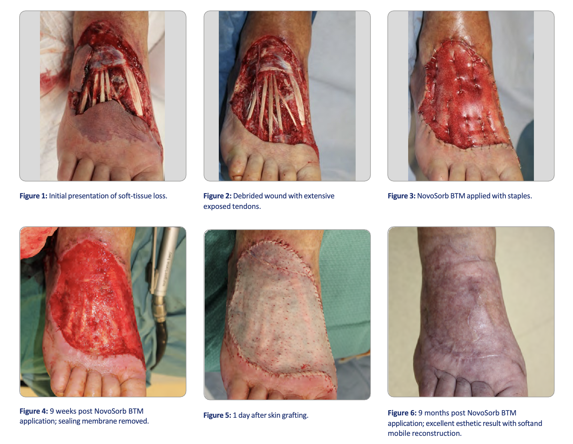 Degloved foot with exposed tendons devoid of paratenon, underwent reconstruction with NovoSorb® BTM to maintain mobility and function.